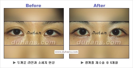 [두한성형외과 경쟁력 쌍꺼풀 재수술, 극한 눈재수술] - [과한 아웃폴드 쌍꺼풀 라인 교정 방법] 관련 이미지 5