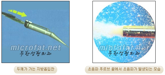 [Duhan Plastic Surgery Liposuction] - [Facial Liposuction] image 4