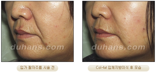 [Duhan Plastic Surgery Facial Autologous Fat Grafting] - [Fat Grafting Guide] image 27