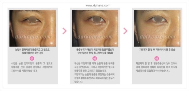 [두한성형외과 경쟁력 눈밑 다크써클 치료] - [다크써클 치료 실패의 원인 분석 안내] 관련 이미지 9