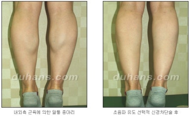 [두한성형외과 종아리 퇴축] - [종아리 퇴축술 재발 재수술] 관련 이미지 14