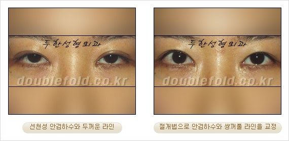 [두한성형외과 경쟁력 눈성형] - [안검하수(졸리운 눈매) 교정 방법 안내] 관련 이미지 21
