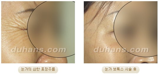 ​[두한성형외과 안티에이징] - [보톡스, 필러, 지방이식을 이용한 주름개선] 관련 이미지 6