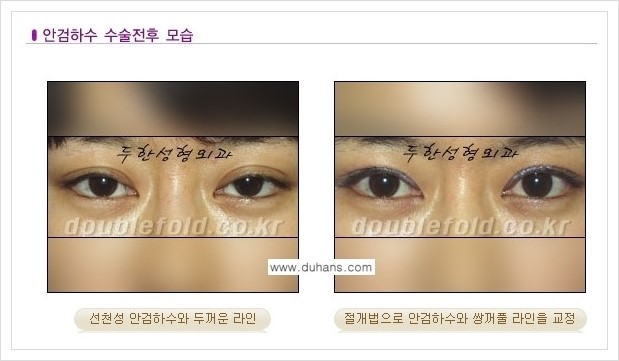 [두한성형외과 경쟁력 쌍꺼풀 재수술, 극한 눈 재수술] - [안검하수(졸리운 눈매) 재수술 안내] 관련 이미지 1