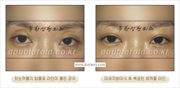 [두한성형외과 경쟁력 쌍꺼풀 재수술, 극한 눈재수술] - [미세지방이식으로 쌍꺼풀 라인의 복원에 관한 질문과 답변] 관련 이미지 2