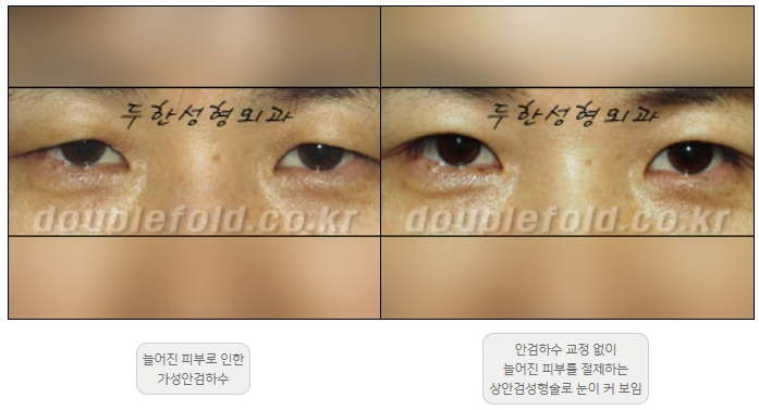 [Ptosis, Duhan Plastic Surgery] - [Sleepy-Looking Eyes, Ptosis Eye Correction] image 8