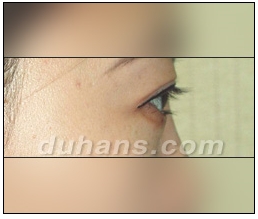 Candidates for Double Eyelid Revision Surgery: Unattractive Double Eyelids, Beautiful Double Eyelids image 42