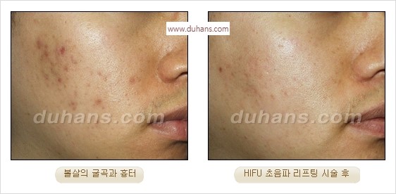 [두한성형외과 경쟁력 주름성형] - [간단하고 부작용 없는 자연스러운 주름제거 방법] 관련 이미지 33