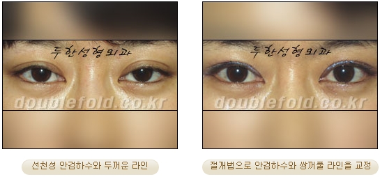 [Duhan Plastic Surgery Secondary Double Eyelid Surgery] - [Sleepy Eye Appearance, Asymmetrical Eye Appearance, Ptosis] image 12