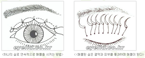 [두한성형외과 눈성형] - [쌍꺼풀수술의 절개법, 매몰법] 관련 이미지 6