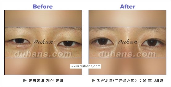 ​[두한성형외과 경쟁력 눈성형] - [자연스럽고 아름다운 쌍꺼풀의 기준] 관련 이미지 29