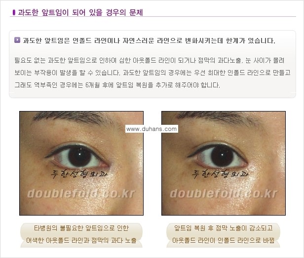 [두한성형외과 극한 재수술, 쌍꺼풀 재수술] - [쌍꺼풀 재수술에서 극복해야 할 극한의 상황과 문제] 관련 이미지 6