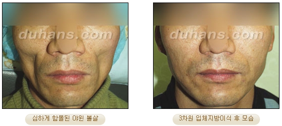[두한성형외과 얼굴자가지방이식] - [볼살, 이마, 측두부] 관련 이미지 31