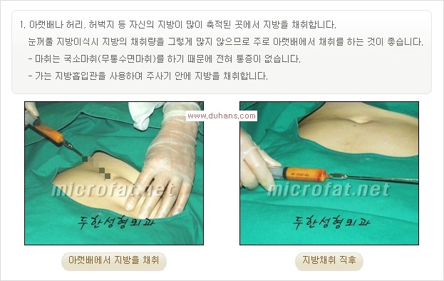 [두한성형외과 경쟁력 쌍꺼풀 재수술, 극한 눈재수술] - [삼중 쌍꺼풀 라인, 눈꺼풀이 함몰된 삼중 라인 교정 안내] 관련 이미지 14