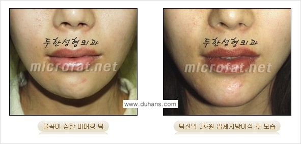 [두한성형외과의 경쟁력 미세지방이식] - [무턱교정 - 턱 미세지방이식 안내 2.] 관련 이미지 17