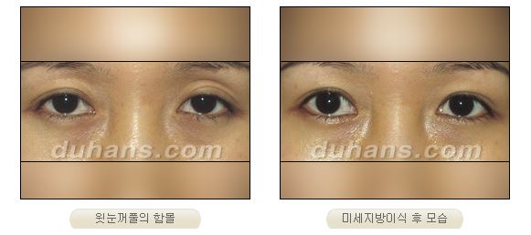 ✨눈 위 꺼짐, 단순 미용이 아닌 기능까지 고려해야 하는 이유✨ 관련 이미지 3