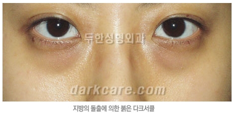 Duhan Plastic Surgery Dark Circle Improvement - What Causes Dark Circles? What Types of Dark Circles Are There? image 14