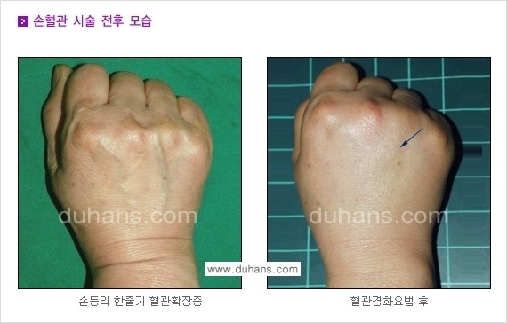 [두한성형외과 정맥 혈관 확장으로 인한 피부개선] - [손, 팔 혈관 확장] 관련 이미지 11