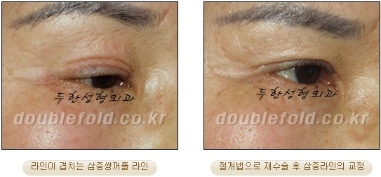 [두한성형외과 눈재수술] - [재수술 방법들] 관련 이미지 25