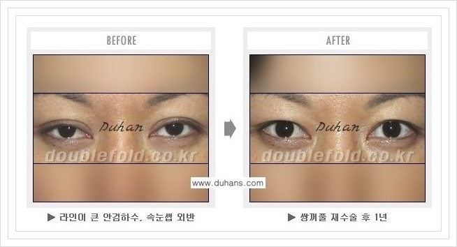 [두한성형외과 경쟁력 쌍꺼풀 재수술, 극한 재수술] - [여러번의 재수술로 인해 흉살이 두터운 경우 교정 방법 안내] 관련 이미지 4