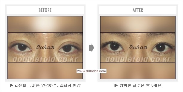 ​[두한성형외과 경쟁력 쌍꺼풀 재수술] - [아름다운 쌍꺼풀 선의 기준과 쌍꺼풀 재수술시 검사와 테스트 안내] 관련 이미지 16
