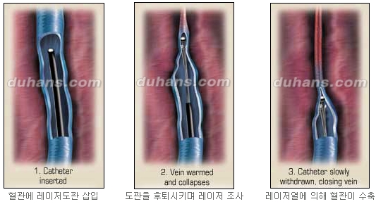 [두한성형외과 정맥류] - [하지정맥류, 정맥확장증, 혈관확장증] 관련 이미지 19