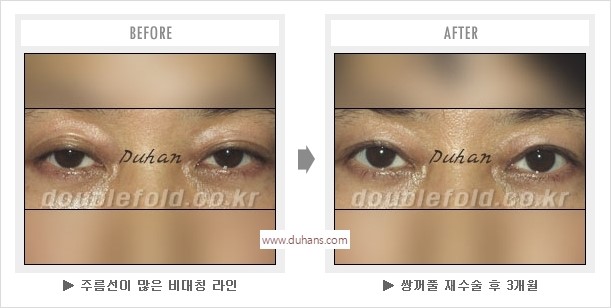 [두한성형외과 경쟁력 눈성형] - [나에게 맞는 어울리는 쌍꺼풀 라인] 관련 이미지 37