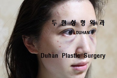 [두한성형외과 입술성형] - [볼륨감 있는 입술 미세지방이식] 관련 이미지 35