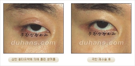 [두한성형외과 경쟁력 쌍꺼풀 재수술 리더 ] - [쌍꺼풀 재수술 과정, 쌍꺼풀 재수술 실패의 원인, 극한 재수술] 관련 이미지 27