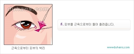 [두한성형외과 경쟁력 눈성형] - [몽고주름 제거수술, 앞트임 수술 안내] 관련 이미지 11