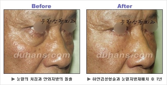 [두한성형외과 경쟁력 동안성형 리더] - ​[미간주름, 이마주름, 안검성형, 이마거상술, 눈썹거상술] 관련 이미지 98