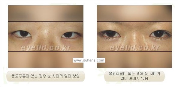 [두한성형외과 경쟁력 눈성형] - [안검하수와 몽고주름에 대한 자주하는 질문과 답변] 관련 이미지 13