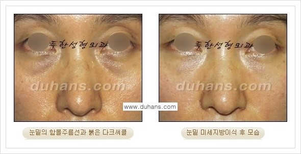 [두한성형외과 경쟁력 눈밑성형] - [꺼진 눈밑, 눈밑 함몰 주름선 눈밑 미세지방이식 안내] 관련 이미지 27