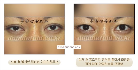 [두한성형외과 경쟁력 쌍꺼풀 재수술, 극한 눈재수술] - [안검하수(졸린 눈매)의 종류 안내] 관련 이미지 6
