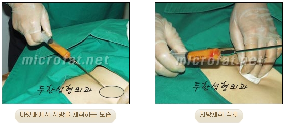 Wrinkle Improvement, Duhan Plastic Surgery - Mouth Lines, Nasolabial Folds image 4