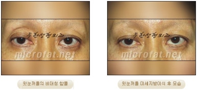 [Doohan Plastic Surgery Autologous Fat Grafting] - [Sunken Eye Fat Grafting] image 16