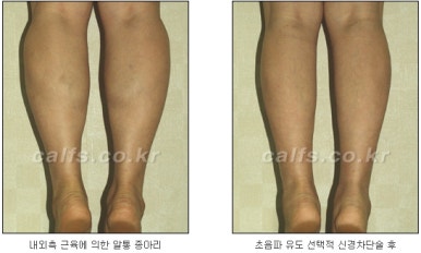 ​[두한성형외과 종아리수술] - [나에게 맞는 종아리성형방법] 관련 이미지 23