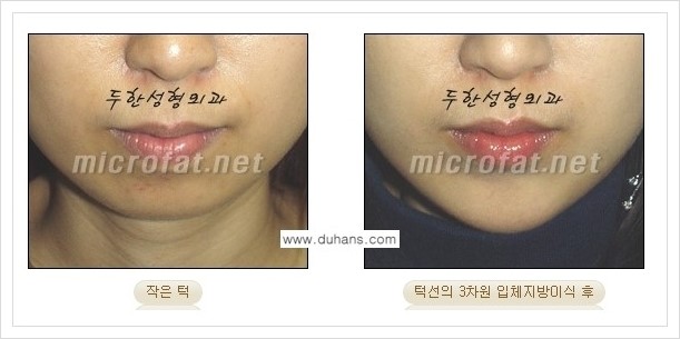 [두한성형외과 경쟁력 안면윤곽 교정] - [미세지방이식으로 무턱, 작은턱, 오목턱, 턱선의 비대칭 교정 안내] 관련 이미지 8