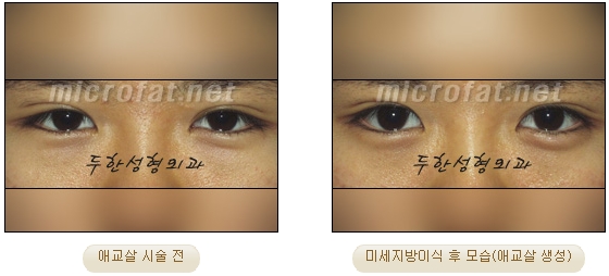 ​[두한성형외과 지방이식] - [애교살] 관련 이미지 27