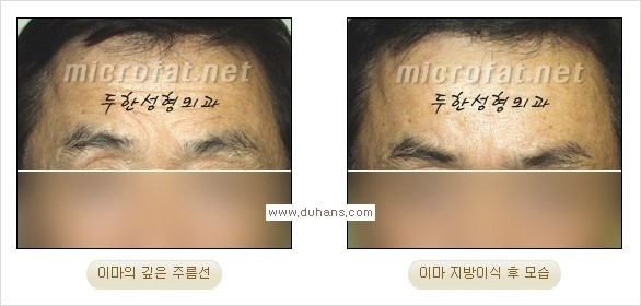 [두한성형외과 경쟁력 주름성형] - [주름 교정을 위한 안전하고 효과적인 미세지방이식] 관련 이미지 16