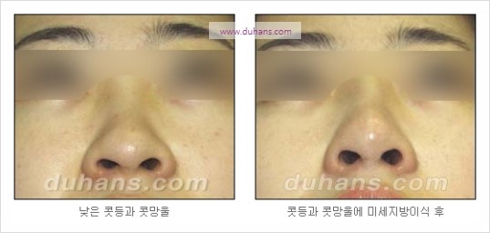 [두한성형외과 경쟁력 코성형] - [코를 높히는 지방이식] 관련 이미지 9
