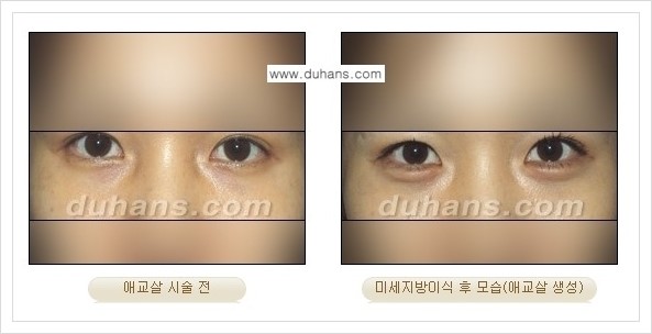 [두한성형외과 경쟁력 눈밑성형] - [눈밑 애교살 시술을 위한 미세지방이식 안내] 관련 이미지 6