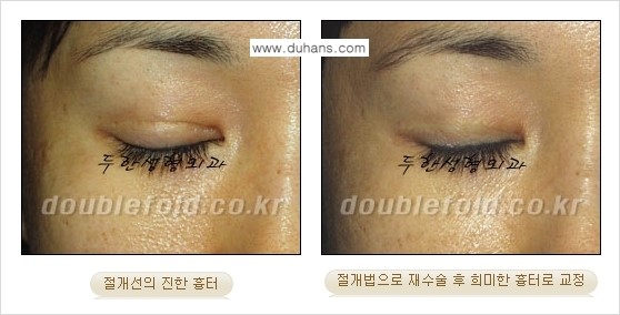 [두한성형외과 함께하는 아름다운 눈매로의 변신] - [흉터선이 진한 경우] 관련 이미지 6