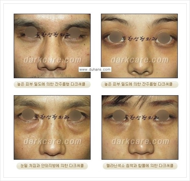 [두한성형외과 경쟁력 다크써클 치료] - [하안검 성형과 눈밑지방 재배치 안내] 관련 이미지 1