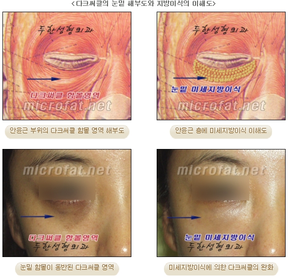[두한성형외과 지방이식] - [다크써클, 눈​밑주름] 관련 이미지 10
