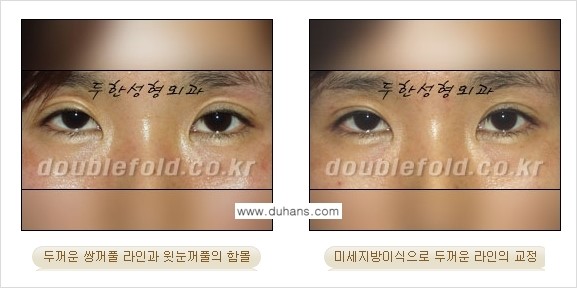 [두한성형외과 NO.1 눈성형] - [함몰된(꺼진) 눈꺼풀에서 쌍꺼풀 라인 교정 2.] 관련 이미지 17