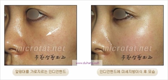 [두한성형외과 경쟁력 입체지방이식] - [인디언밴드, 앞광대주름 미세지방이식] 관련 이미지 12