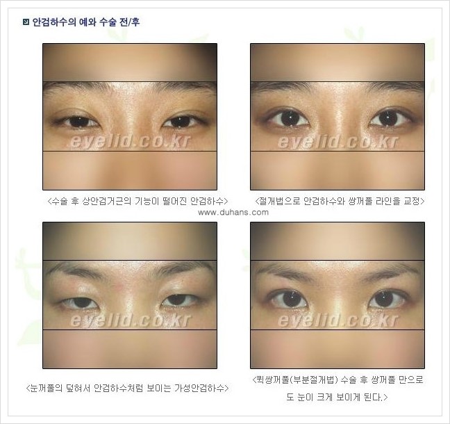 [두한성형외과 경쟁력 쌍꺼풀 재수술] - [안검하수 성형 흔한 질문과 답변 모음] 관련 이미지 2