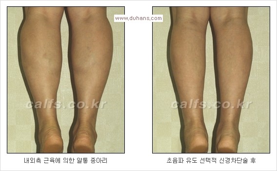 [두한성형외과 Dr. 컬럼] - [종아리 근육퇴축술로 가장 선호하는 비절개 초음파 유도 선택적 신경차단술] 관련 이미지 4