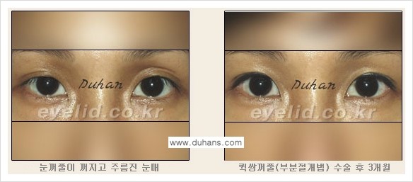 [두한성형외과 FOCUS 눈성형] - [퀵쌍꺼풀에 대한 질문과 답변들] 관련 이미지 5